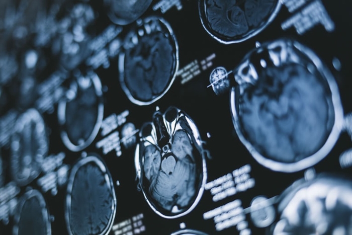 Inteligența artificială ajută la identificarea hemoragiei cerebrale