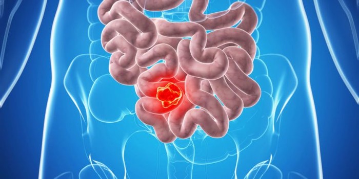 6 semne și simptome ale cancerului de colon pe care toată lumea le ignoră