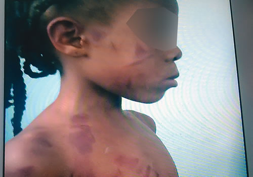 SHOCKING: SEE What This 18-Yr-Old Mum Did To Her Five-Yr-Old Daughter [PHOTO]