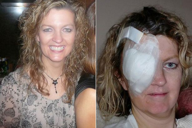 'I lost my eye to skin cancer because cheap holiday sunglasses gave me no protection
