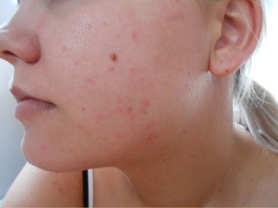 Home remedies to get rid of blemishes